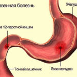 Лечебные свойства чеснока в борьбе с артериальной гипертонией