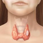 Дисфункция щитовидной железы