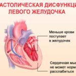 Дисфункция желудочка сердца