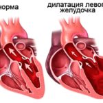Нарушение функций сердечного желудочка слева