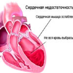 Недостаточность работы сердечной мышцы