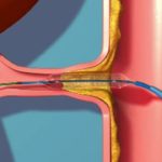 Резкое сужение почечных артерий - стеноз