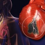 Снижение риска появления инфаркта миокарда