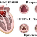 Стенозы митрального, аортального клапана