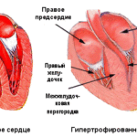 Уменьшение уровня гипертрофии левой части желудочка сердца