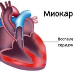Воспалительный процесс в сердечной мышце