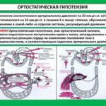 Гипотензия ортостатического типа