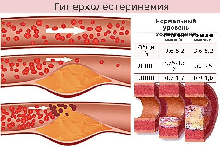 Alimentos prohibidos en hipercolesterolemia