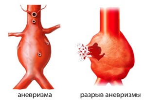 Классификация аневризмы сонной артерии