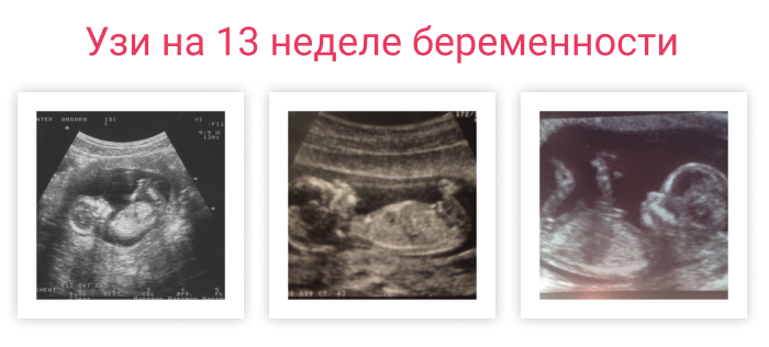 Узи ребенка на 13 неделе. Как выглядит ребенок на УЗИ В 13 недель. УЗИ на 13 неделе беременности скрининг. УЗИ 13 недель беременности скрининговое.