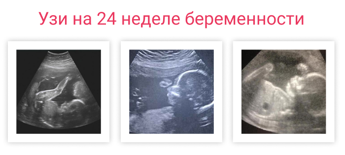 24 неделя б. Параметры плода 24 недели. УЗИ 24 недели беременности.