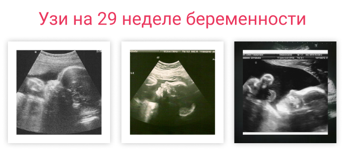 28 недель двойней. УЗИ плода 29 недель норма. УЗИ плода 29 недель беременности. УЗИ 29 недель беременности параметры плода. 28 -29 Недель беременности УЗИ.