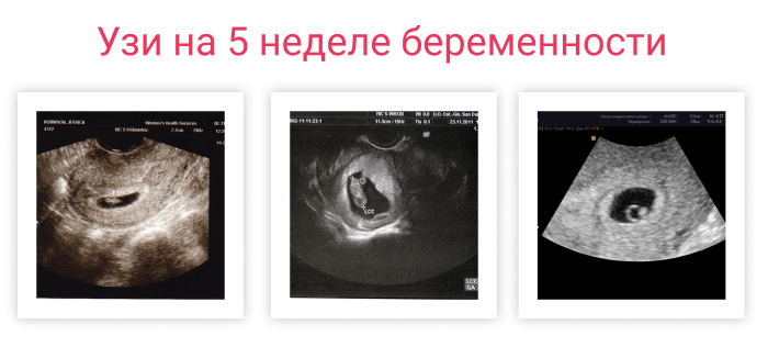 Во второй половине недели. Как выглядит эмбрион в 5 недель на УЗИ. Как выглядит плод на УЗИ на 5 неделе. УЗИ на 5 акушерской неделе беременности. УЗИ на 5 неделе беременности от зачатия.